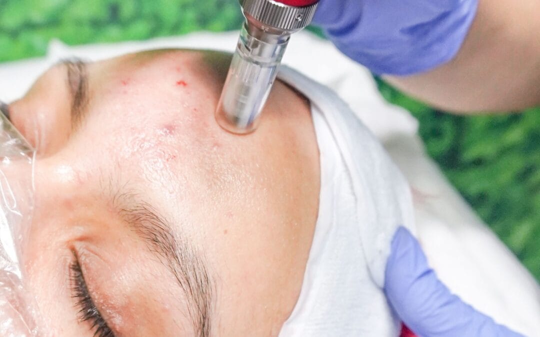 Microneedling Brampton